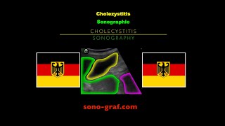 Sonographie  Cholezystitis [upl. by Euseibbob744]