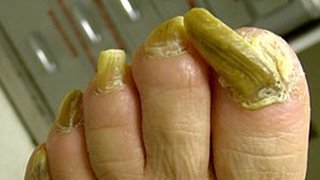 How to Get Rid of Toenail Fungus in a Day Watch till the end [upl. by Etteuqaj]