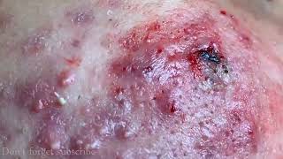 CYSTIC ACNE REMOVAL  Inflammatory Acne Acne Skin Treatment [upl. by Aynahs]