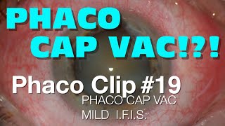 Phaco Clip 19  Phaco Cap Vac and Mild IFIS [upl. by Ylellan]