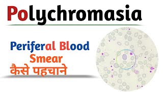 Polychromasia  Periferal blood smear [upl. by Vilhelmina562]