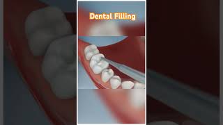 Dental filling [upl. by Assehc]