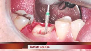 IMPLANTE INMEDIATO COLOCADO EN EL SEPTUM RADICULAR [upl. by Adamek530]