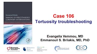 Case 106 PCI Manual  Tortuosity troubleshooting [upl. by Aggappora]