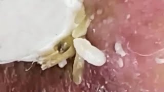 Blackheads amp Whiteheads Satisfying Removal 0294 [upl. by Codee695]