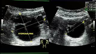 ultrasound video shows left hydrosalpinx [upl. by Riti]