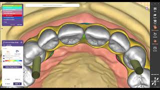 DESIGN FULL ARCH END GINGIVA MULTIUNITE BRIDG51 [upl. by Ekyt]