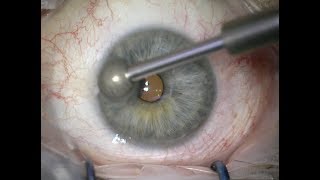 Alcohol debridement and diamond burr for recurrent corneal erosions [upl. by Dina]