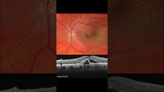 POLYPOIDAL CHOROIDAL VASCULOPATHY MULTIMODAL ANALYSIS For more images like this visit wwwretinograp [upl. by Jerusalem]