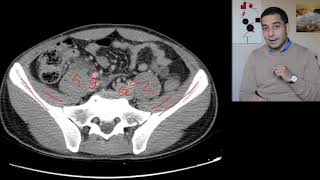 Appendicitis on CT scan  Radiology cases  التهاب الزائدة الدودية على الطبقي  حالات سريرية الأشعة [upl. by Nyrret457]