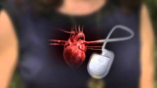 DefibrillatorPacemaker Whats the Difference [upl. by Elenore]