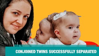 Real Conjoined Twins Rarer than One in a Million Separating Abigail and Micaela Bachinskiy [upl. by Iht683]