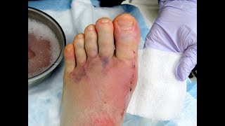 Bunion amp Hammer Toe Surgery Best PROVEN options [upl. by Zenitram]