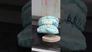 Zirconia bridge trendingshorts viralvideo dentist [upl. by Odeen]