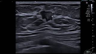 11 Breast Lesion  Ultrasound Aplio aseries  Canon Medical Systems [upl. by Borer781]