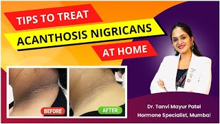 Dark Patch Acanthosis Nigricans Treatment by Dr Tanvi Mayur Patel [upl. by Enixam858]