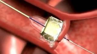 Edwards Sapien Transcatheter Heart Valve [upl. by Eirena]