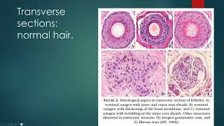 Alopecia Dermpath Lecture ft Dr Niedt [upl. by Anurb]