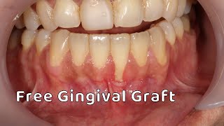 Free Gingival Graft [upl. by Alana399]