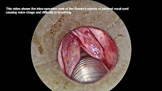 Reinkes edema surgical videos [upl. by Onafets]