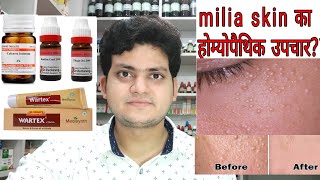 Milia Homeopathic medicine for Milia Milium Cyst Explain [upl. by Leroi]