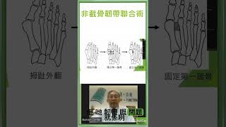 韌帶聯合術有什麼程序What is the syndesmosis procedure [upl. by Neille]