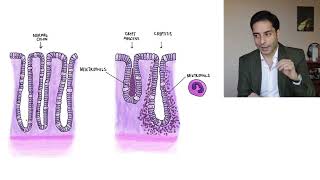 Inflammatory Bowel Disease 1  الامتحان الوطني الموحد  الداء المعوي الالتهابي [upl. by Neelak]