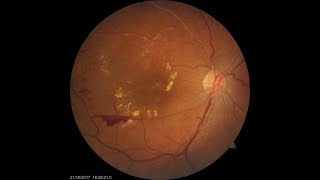 Treatment for Retinal Vein Occlusion [upl. by Acireh179]