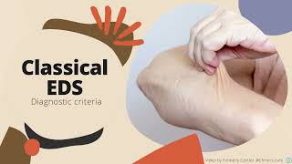 Classical EhlersDanlos Syndrome Diagnostic Criteria [upl. by Diarmid]