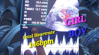 Live Fetal Heartbeat❤️ Sound With Fundoanterior Placenta  Pregnancy With IUCD  Heartrate BoyGirl [upl. by Lenno]