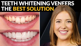 Whiten Your Teeth Like a Pro  The Secret Tip No One Tells You [upl. by Ettevey876]