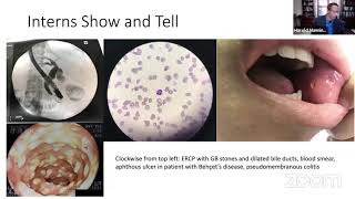 Functional Dyspepsia FD [upl. by Harihs]