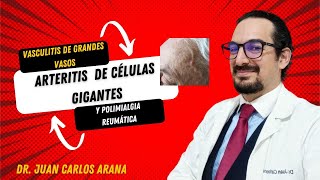 Polimialgia reumática y arteritis de células gigantes [upl. by Rahcir608]