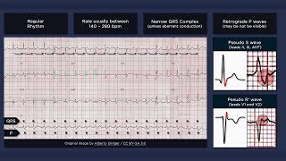 Atrioventricular Nodal Reentry Tachycardia AVNRT ECG [upl. by Aneeles]