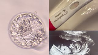 Successful Frozen Embryo Transfer  31 weeks 1 day [upl. by Ydasahc977]