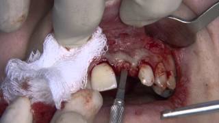 Surgical exposure of implant using tunnel technique  Dr Howard Gluckman [upl. by Lacy]