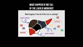 What happens if not all of the liver is working liver liverhealth livercirrhosis health [upl. by Letnom]