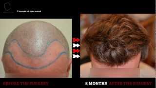 FUE 2867 Ufs MeDiKemos Hair Transplantation ENG [upl. by Pliam]