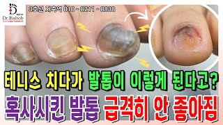 💦무좀 발톱💦 혹사당한 발톱이 보낸 신HO 😣 발톱닥터 무좀발톱 무좀발톱스케일링 무좀발톱관리 지축역 [upl. by Shell]