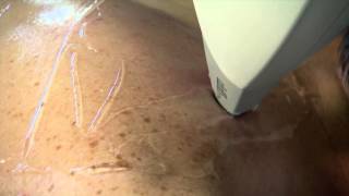 Lightsheer Laser Hair Removal [upl. by Maillil]