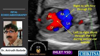 Fetal Echocardiography Basics Ultrasound  Dr Anirudh Badade [upl. by Pevzner]