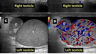 ORQUIEPIDIDIMITIS IZQUIERDA MASCULINO DE 32 AÑOS CON DOLOR TESTICULAR E INFLAMACIÓN [upl. by Nosreip]