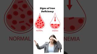 Signs of Iron Deficiency anemiairondeficiencyshorts [upl. by Winson829]