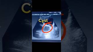 Hemorrhagic Cyst Ovary  Adnexal Cyst  Cyst with internal echoes and Septations  Ovarian Cyst [upl. by Charron]