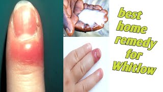 How to get rid of Whitlow on a finger permanently at home using the best home remedy [upl. by Llet439]