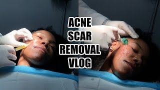 Subcision and Microneedling with PRP Procedure  Skin Vlog 2 [upl. by Manus]