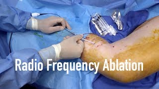 Radio frequency Ablation of Varicose Vein how does it works [upl. by Nadabb]