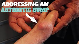 HOW TO ADDRESS AN ARTHRITIC BUMP [upl. by Zebulon]