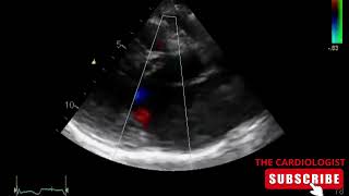 Hypertrophic Cardiomyopathy  SAM  MR [upl. by Hines855]