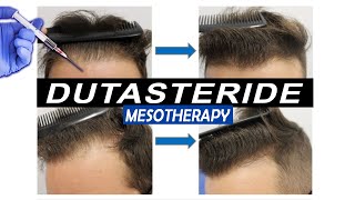 Mesotherapy with Dutasteride Injections Pros and Cons and what Results to expect [upl. by Wynn]